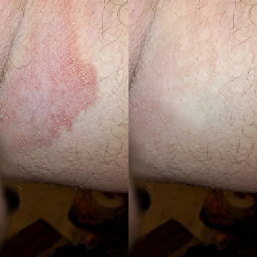 RashBreak Formula Men