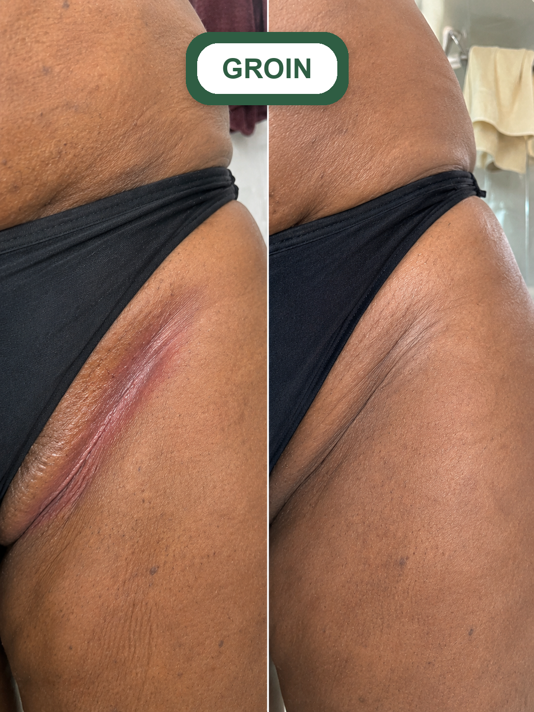 Clairon result groin fold