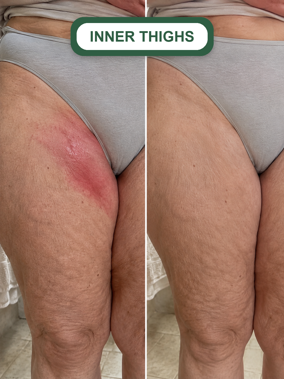 Clairon result inner thighs