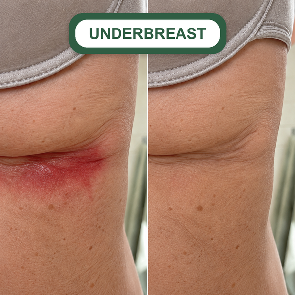 Under-breast fold rash before and after Clairon