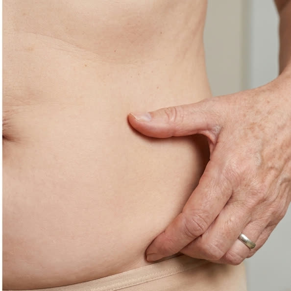 Apron Belly Fold after